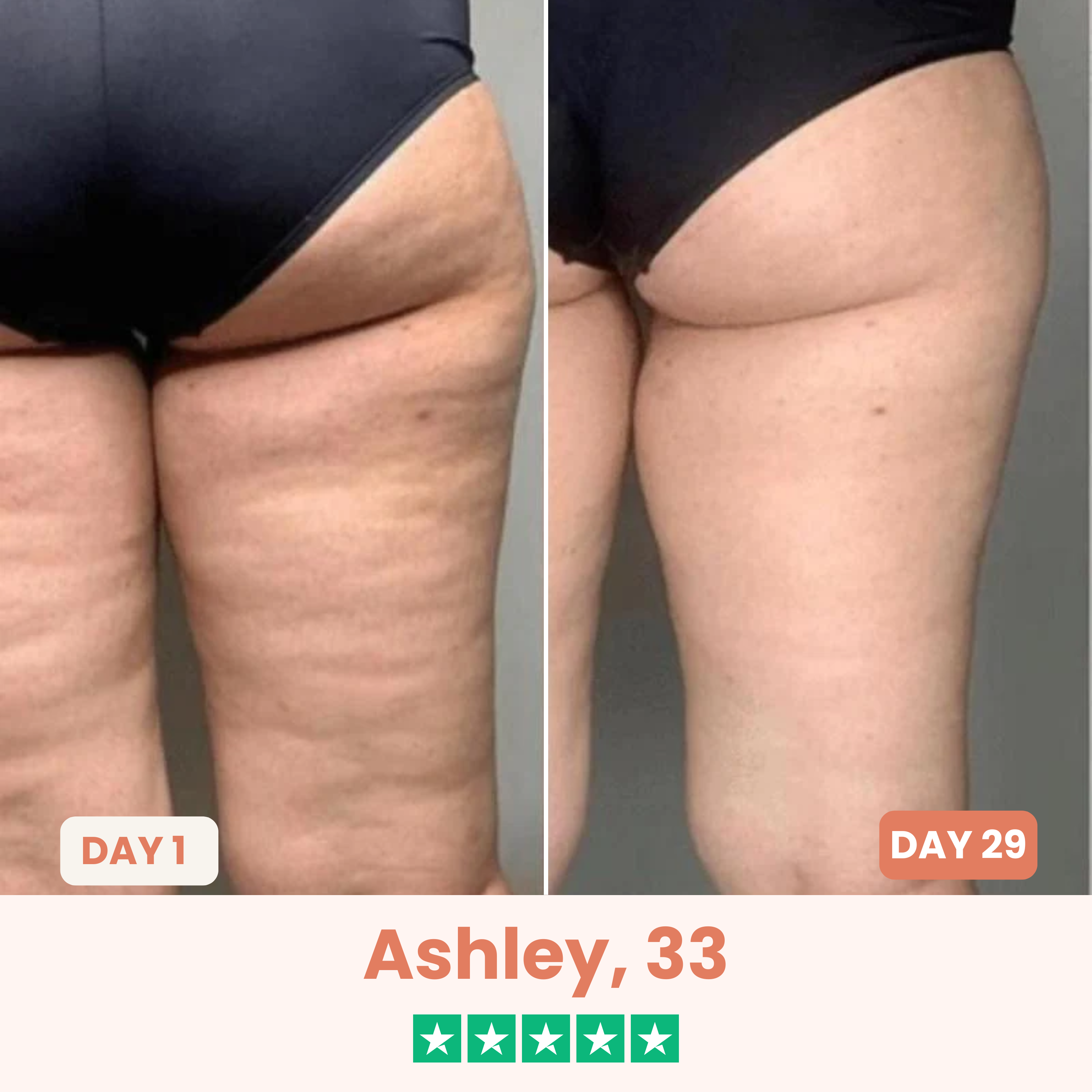 The Cellōa Lift : Say goodbye to your cellulite now