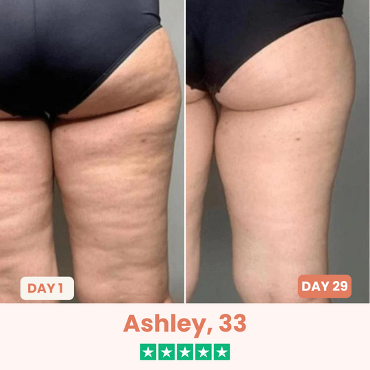 The Cellōa Lift : Say goodbye to your cellulite now