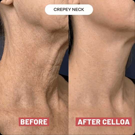 The Cellôa™ Lift (New Version UK)