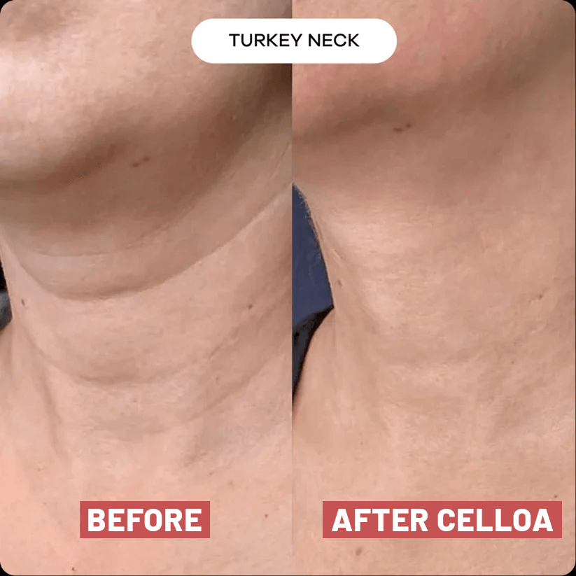 The Cellôa™ Lift (New Version UK)
