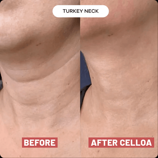 The Cellôa™ Lift (New Version UK)