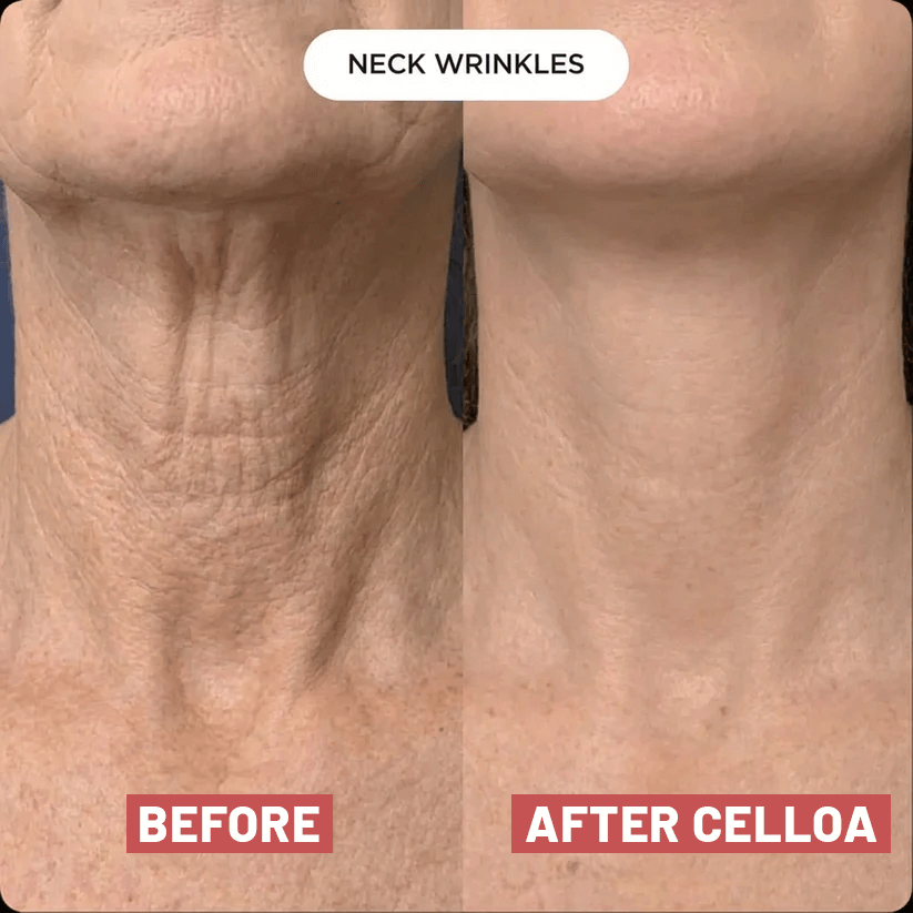 The Cellôa™ Lift (New Version)